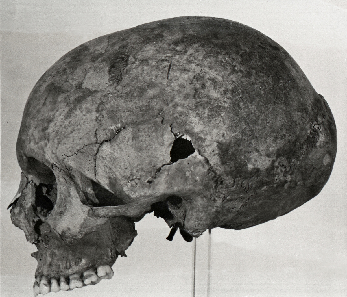 Grav 31. Skelett 5. Kranium, från sidan.