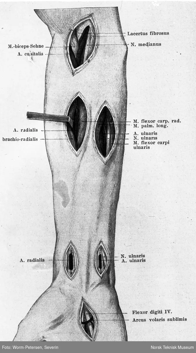 Medisinske illustrasjoner, kirurgiske instrument 1928 (underarm)