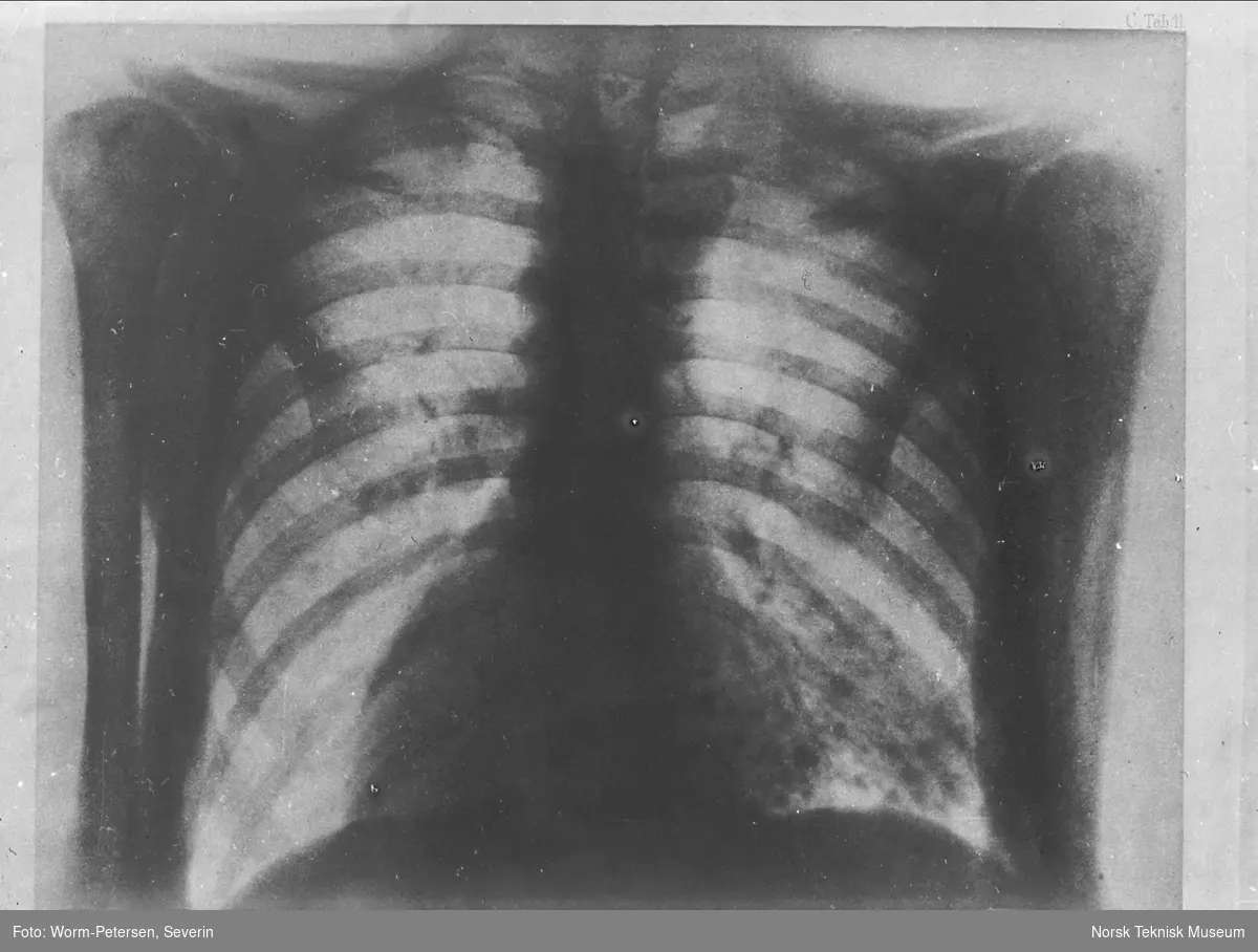 Røntgenbilde; ribbein, lunge