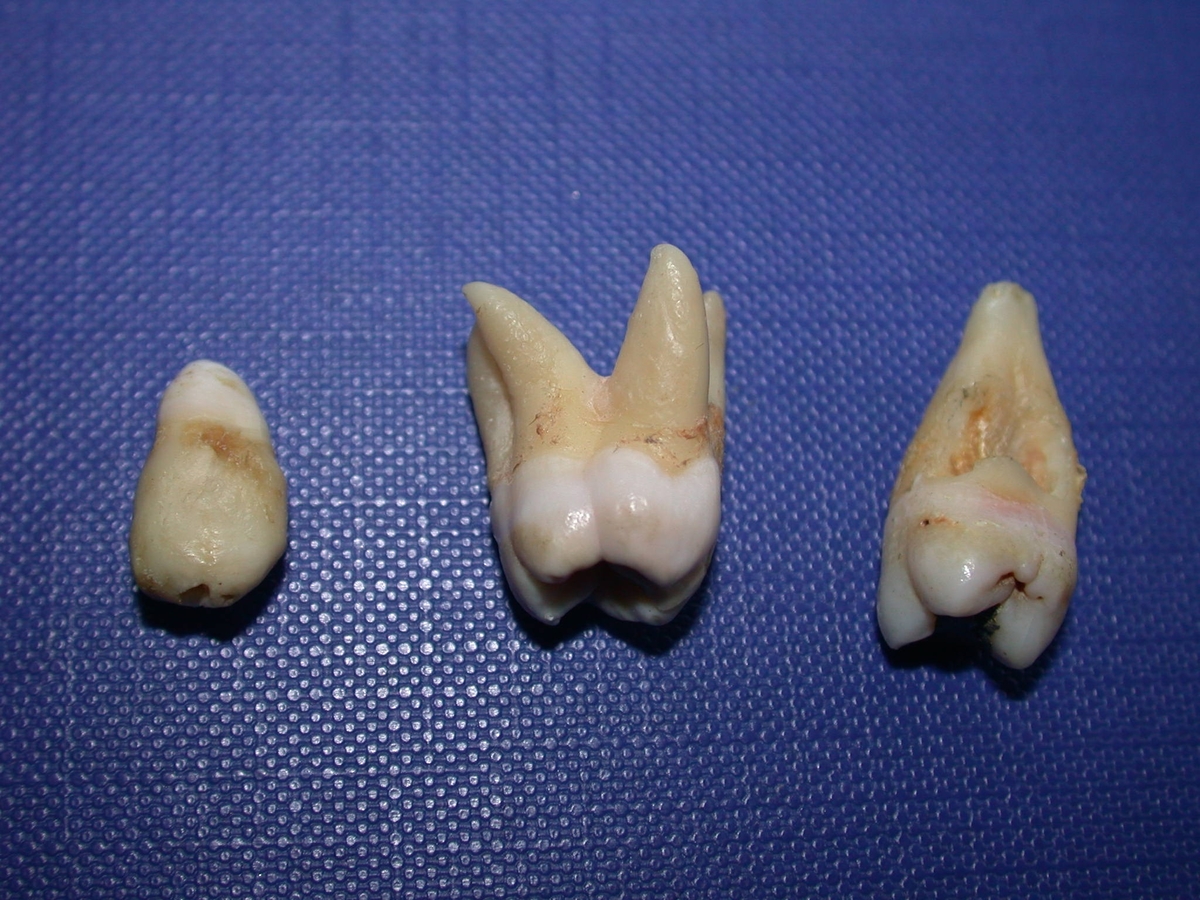Glassbeholder(A)  inneholdende 3 stk. mennesketenner (B-D)
B: 6-års jeksel med 4 røtter
C: en kortvokst tann
D: 12-års jeksel med sår i midten